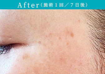 プラズマホワイト After（施術1回／７日後）