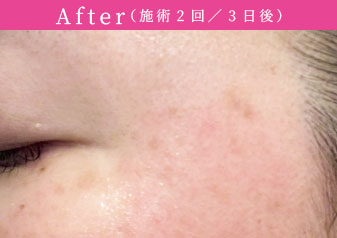 プラズマホワイト After（施術2回／3日後）